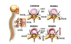 腰椎的句子,关于自嘲腰椎间盘突出的句子？